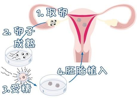 妇科微创